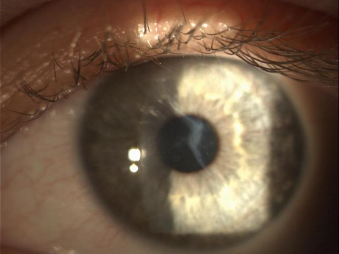 cheratoplastica Paziente affetto da cicatrice corneale traumatica in zona ottica