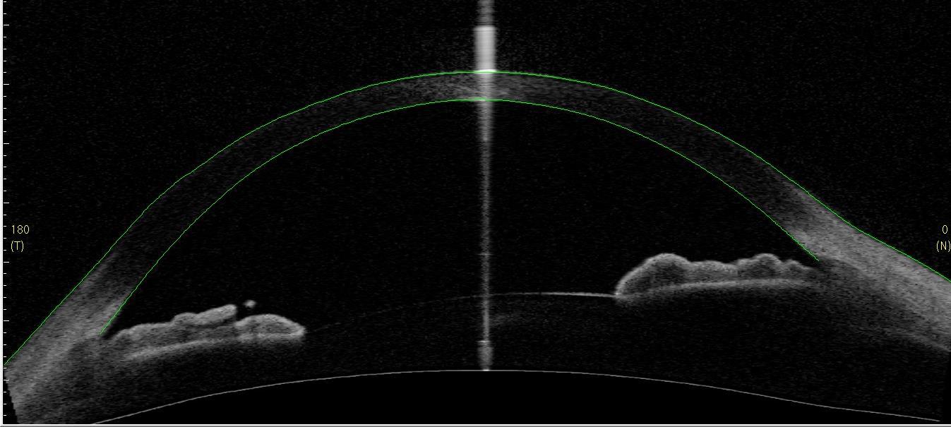 Immagine tomografica del segmento anteriore che evidenzia un angolo irido-corneale aperto.